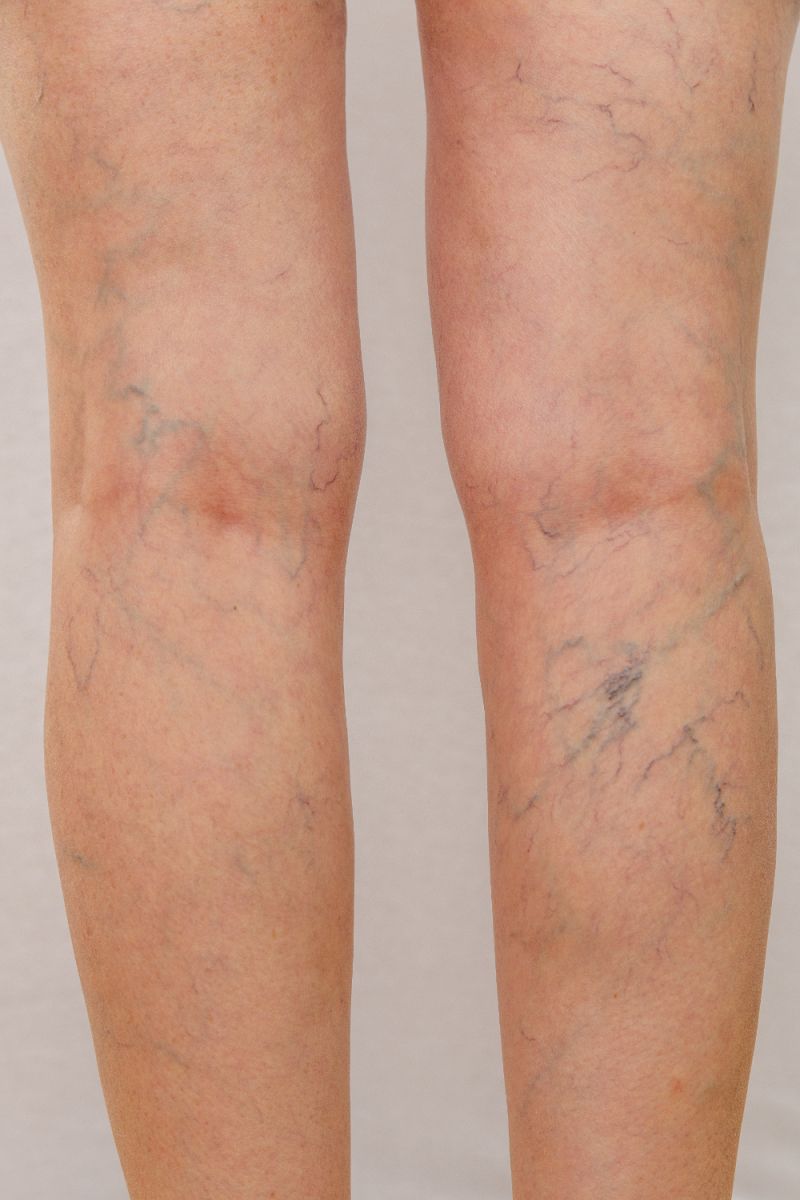 The Do’s and Don’ts of Spider Vein Treatment: Expert Advice for Flawless Legs Image