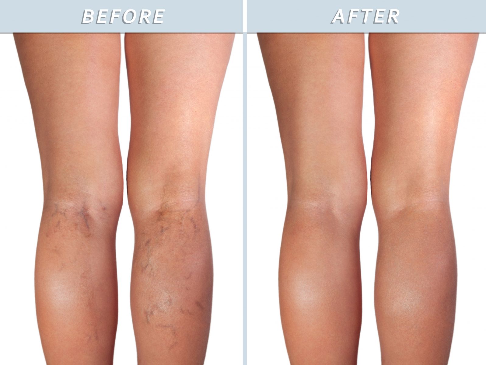 Spider Veins, Be Gone! Why Cosmetic Sclerotherapy Is Your Ticket to Confident, Carefree Legs Image