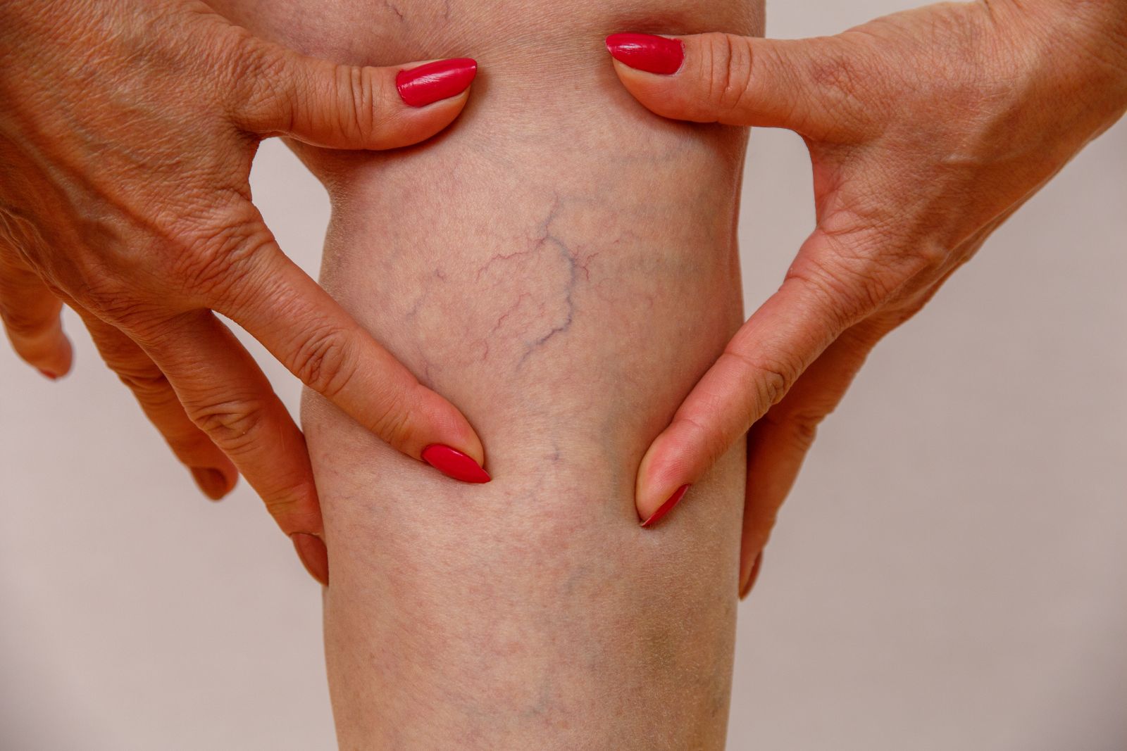 6 Common Misconceptions About Spider Vein Treatments Image