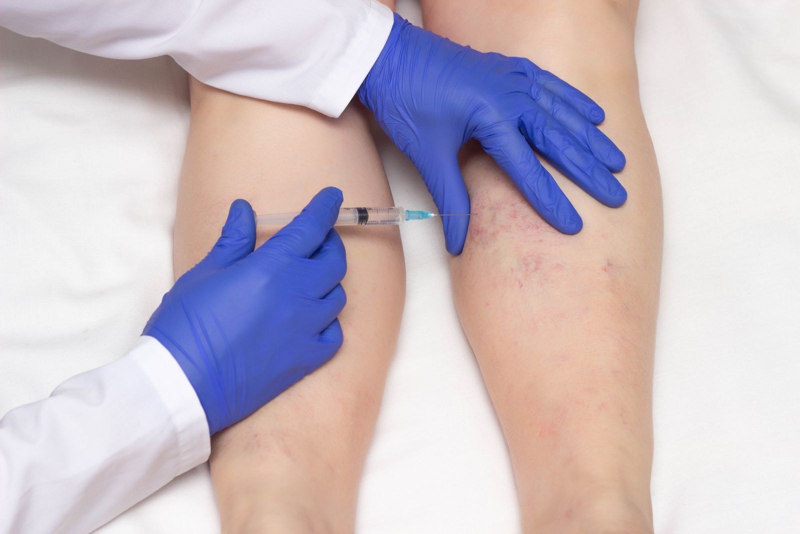 5 Key Benefits of Cosmetic Sclerotherapy for Spider Veins Image