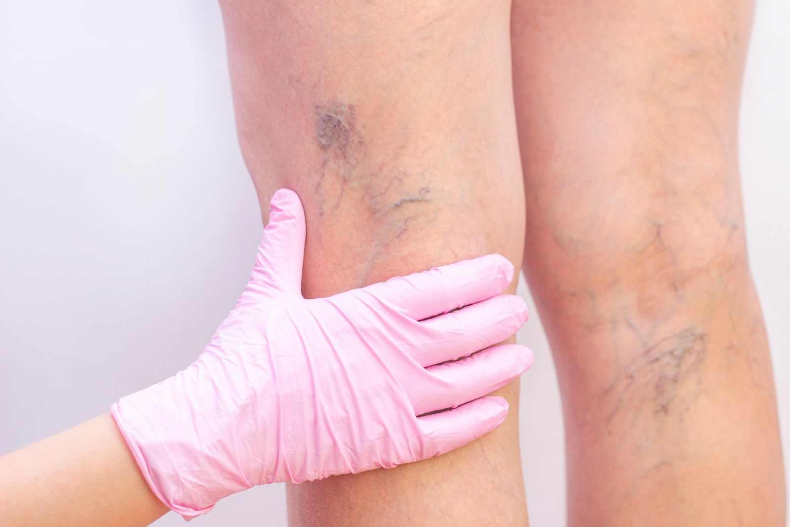 Not Just Cosmetic: How Vein Treatments Can Boost Your Health and Confidence Image