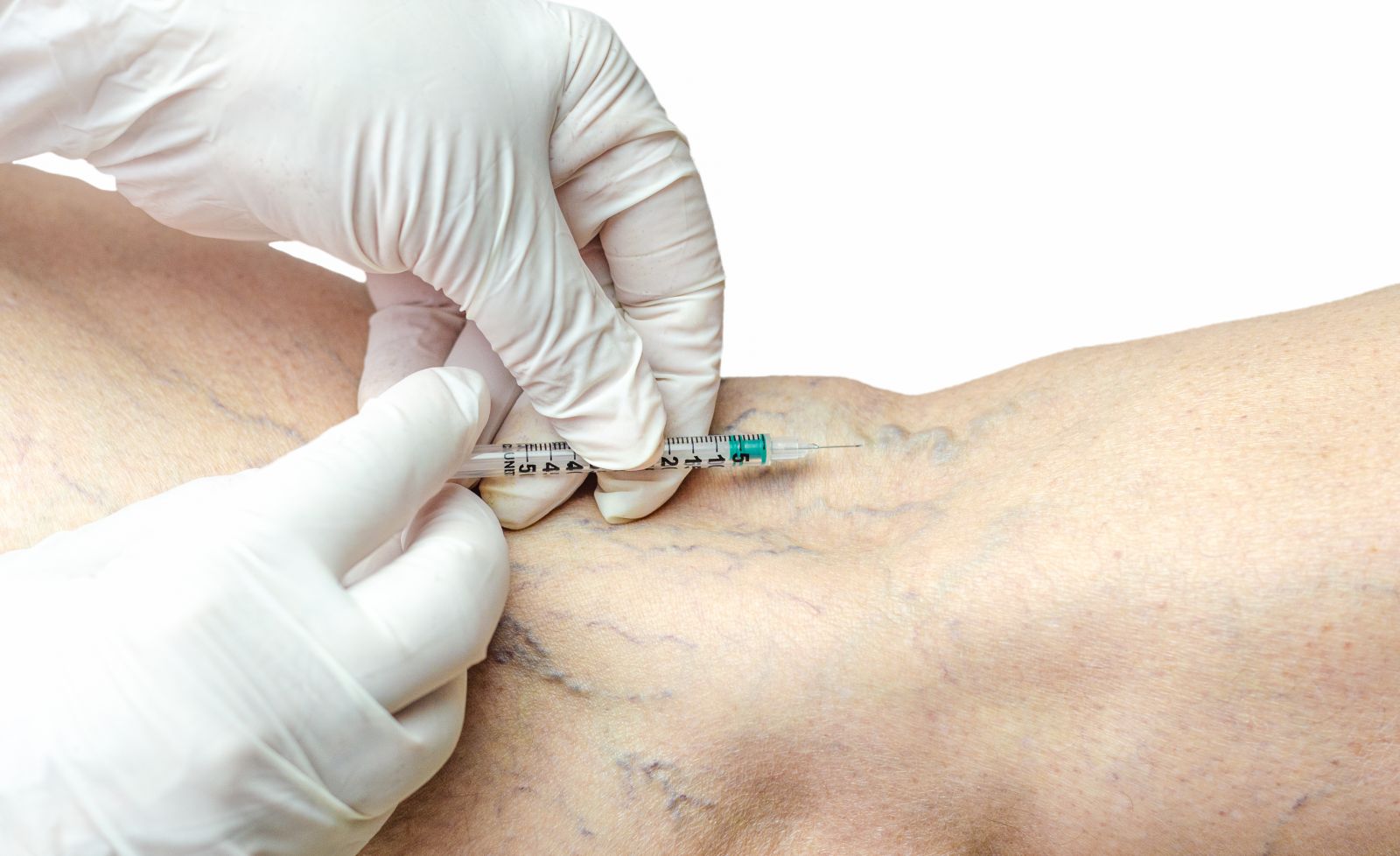 Say Goodbye to Spider Veins: The Magic of Sclerotherapy Image